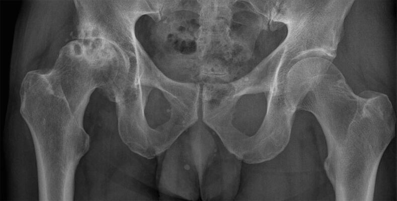 Stage 3 arthrosis of the hip joint on X-ray