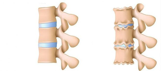 Osteocondrosis from the inside