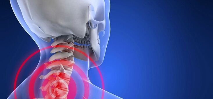 Osteocondrosis of cervical region