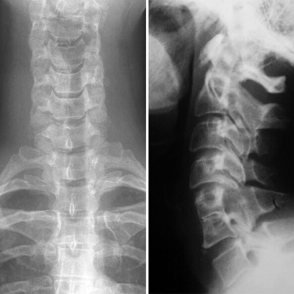 X-cervical spine