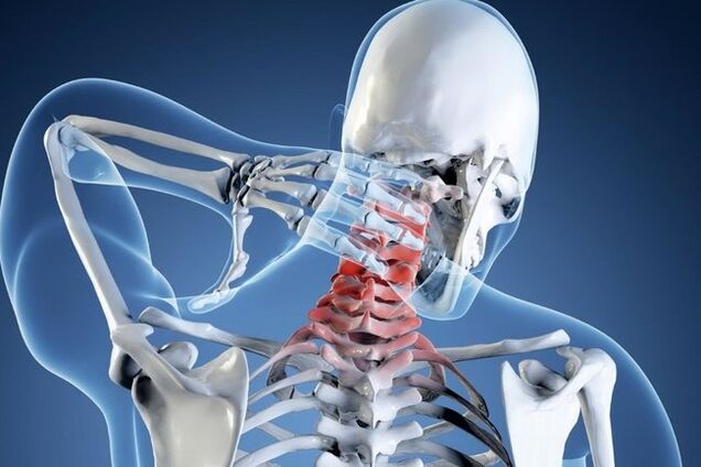 Osteocondrosis of cervical region