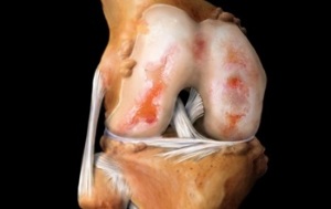 What is osteoarthritis of the knee joint