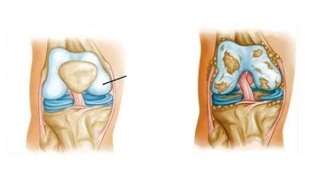 pathological changes in knee osteoarthritis