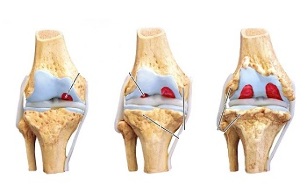 stages of osteoarthritis of the knee joint