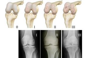 Methods of diagnosis of knee osteoarthritis
