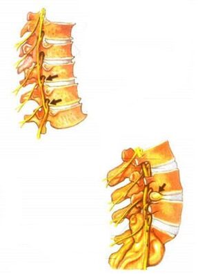 description of osteochondrosis of the spine