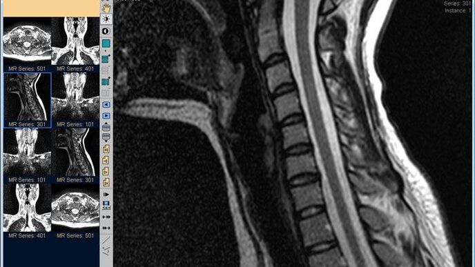 MRI of the cervical spine is the best way to diagnose neck pain