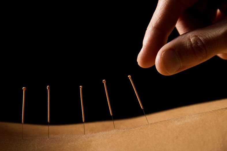 acupuncture for back pain