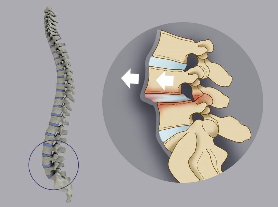 vertebral displacement as a cause of low back pain